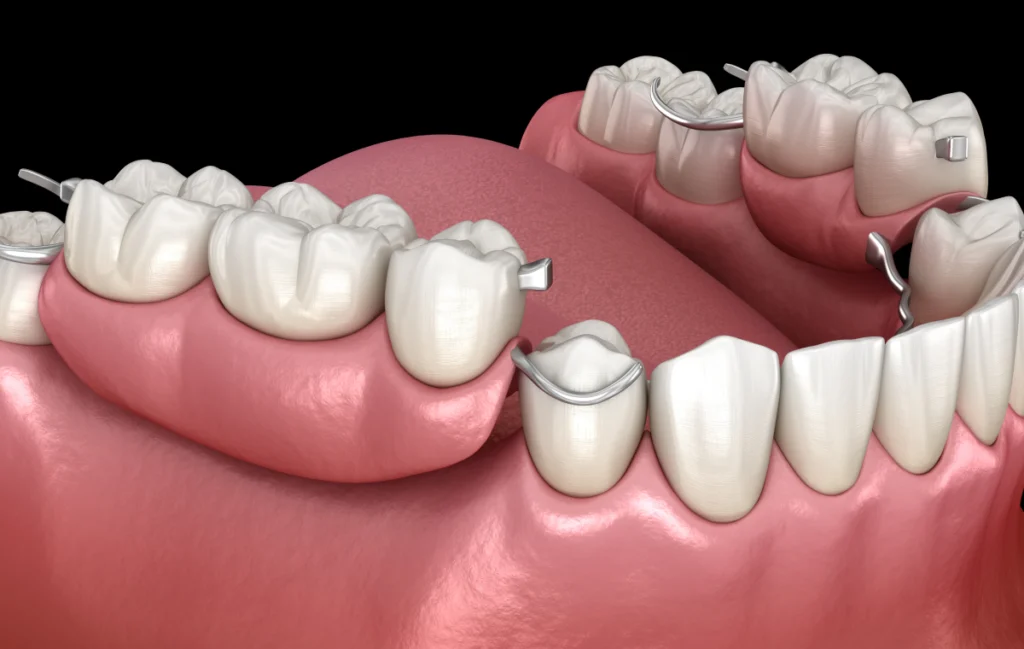adobestock Restauration prothétique Chirurgiens-dentistes à Juan-les-pins | Cabinet dentaire du Lys