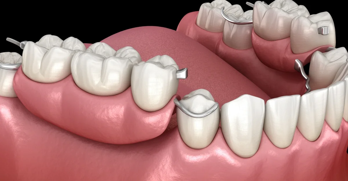 extraction implantation chirurgiens juan les pins Restauration prothétique Chirurgiens-dentistes à Juan-les-pins | Cabinet dentaire du Lys