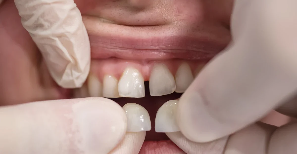 extraction implantation sans incision juan les pins Facettes Chirurgiens-dentistes à Juan-les-pins | Cabinet dentaire du Lys