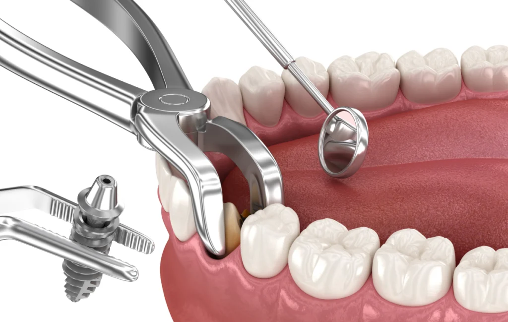 extraction implantation extraction implantation Extraction implantation immédiate Chirurgiens-dentistes à Juan-les-pins | Cabinet dentaire du Lys