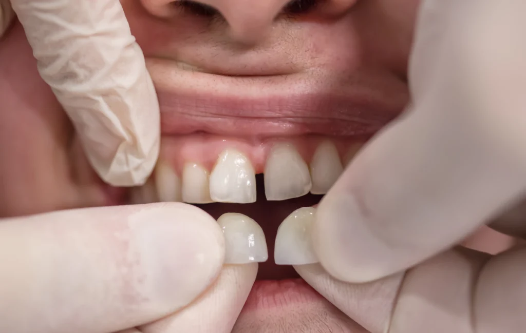 facettes facettes Facettes Chirurgiens-dentistes à Juan-les-pins | Cabinet dentaire du Lys